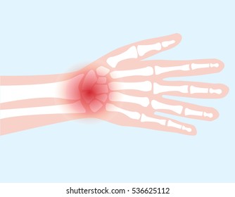hand bone joint injured