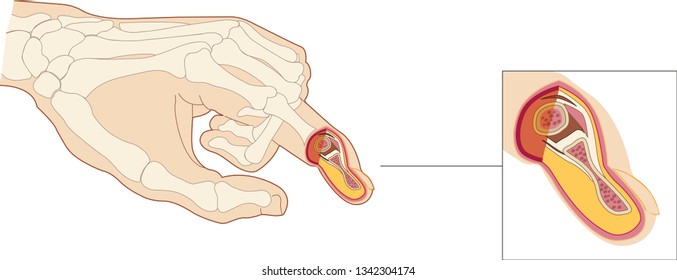 Hand bones and finger joint, a typical synovial joint