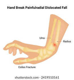 Hand Break Painfulradial verteilte Fall Science Design Vektorgrafik
