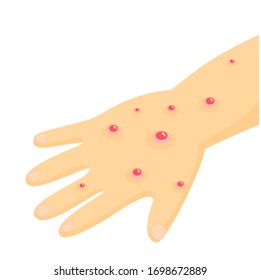 Hand  Disease Vector on white background