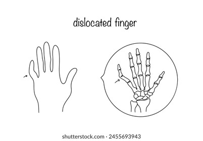Hand with a dislocated little finger. A pathological condition in which the articular surfaces are displaced. Injury requiring medical intervention. Vector illustration.
