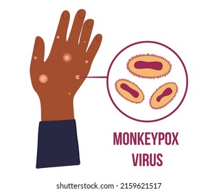 Hand drawn black African hand with many papules because of Monkey Pox virus outbreak pandemic. Virion cell diagram. rare disease from Africa. Vector illustration isolated on white