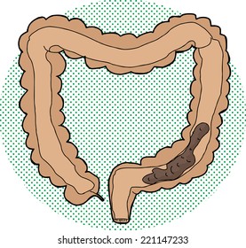 intestino extraído a mano dentro del intestino grueso humano