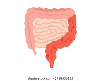 Hand Drawn Colitis Disease in Intestines