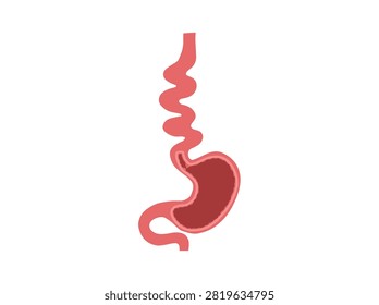 Hand Drawn Diffuse Esophageal Spasm