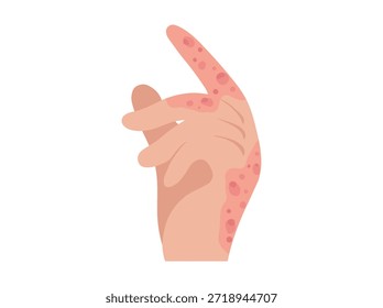 Eccema de la mano Dermatitis Enfermedad