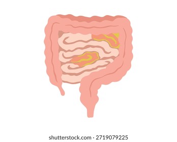 Enfermedad de la enteritis dibujada a mano en los intestinos