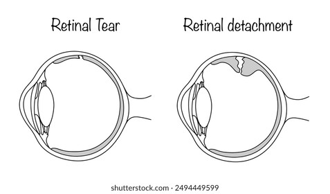 Hand drawn eyeball with retinal tear and retinal detachment. Disease of the organ of vision. Vector illustration.