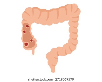 Enfermedad de los pólipos intestinales dibujados a mano