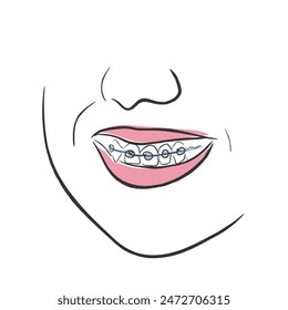 línea dibujada a mano Vector de aparatos ortopédicos en los dientes. Concepto de procedimientos dentales. elemento de pósters de salud bucal