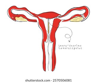 hand drawn line art vector of Intra Uterine Contraceptive