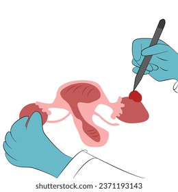 dibujo a mano, Concepto Evitar la infección por VPH mediante vacunación antes de infectarse.