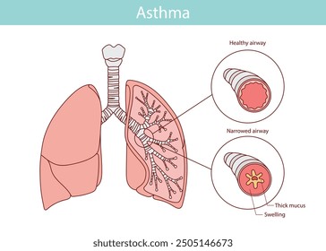 handgezeichnete medizinische Illustration von Lungenasthma