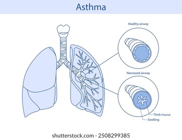 handgezeichnete medizinische Illustration von Lungenasthma