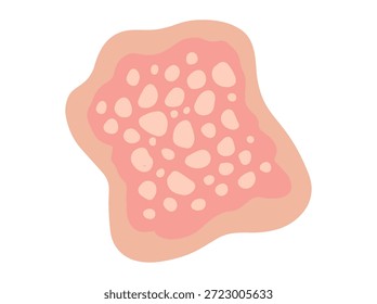 Dermatitis seborreica dibujada a mano