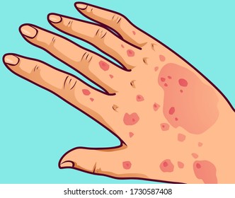 Hand mit Ekzem, Vektorgrafik