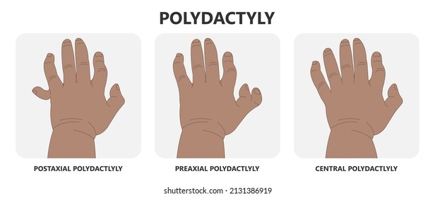 Hand Finger Gene Prader Willi Band Autism Surgery Baby Simple Thumb Apert Minor Born Toes Feet Fused Club Hand Cleft Birth Ulnar Multiple Leg Clubfoot Child Claw Aplasia Wrist Forearm Deformity Extra