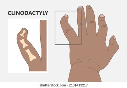 Hand Finger Gene Prader Willi Band Autism Surgery Baby Simple Thumb Apert Minor Born Toes Feet Fused Club Hand Cleft Birth Ulnar Multiple Leg Clubfoot Child Claw Aplasia Wrist Forearm Deformity Extra