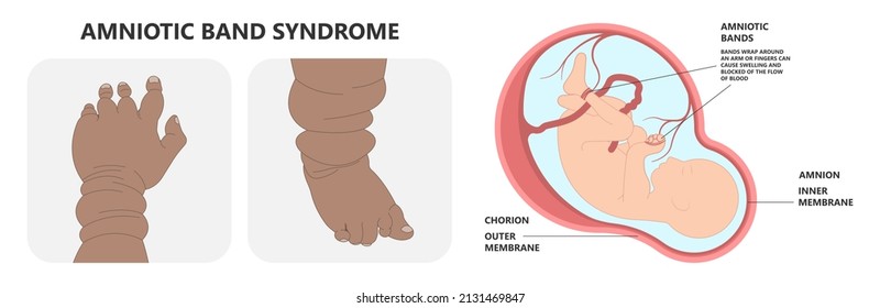 Hand Finger Gene Prader Willi Band Autism Surgery Baby Simple Thumb Apert Minor Born Toes Feet Fused Club Hand Cleft Birth Ulnar Multiple Leg Clubfoot Child Claw Aplasia Wrist Forearm Deformity Extra