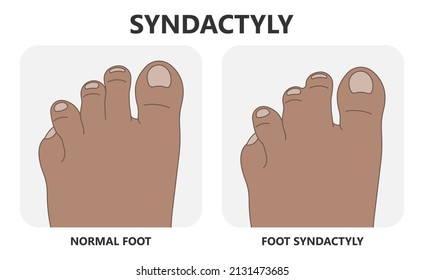 Hand Finger Gene Prader Willi Band Autism Surgery Baby Simple Thumb Apert Minor Born Toes Feet Fused Club Hand Cleft Birth Ulnar Multiple Leg Clubfoot Child Claw Aplasia Wrist Forearm Deformity Extra