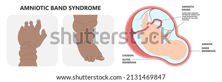 Hand finger gene prader willi band autism surgery baby simple thumb Apert minor born toes feet fused club hand Cleft Birth Ulnar multiple leg clubfoot child claw aplasia wrist forearm deformity extra Foto d'archivio © 