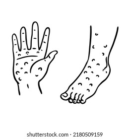 hand foot  disease  . Hand draw vector illustration eps10

