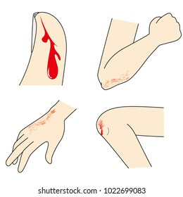 Hand and foot injuries