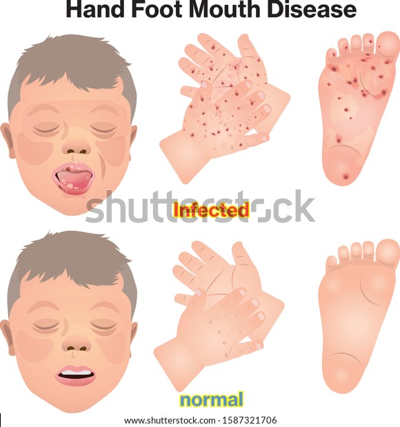 Hand Foot Mouth Disease Contagious Diseases Stock Vector Royalty Free 1587321706