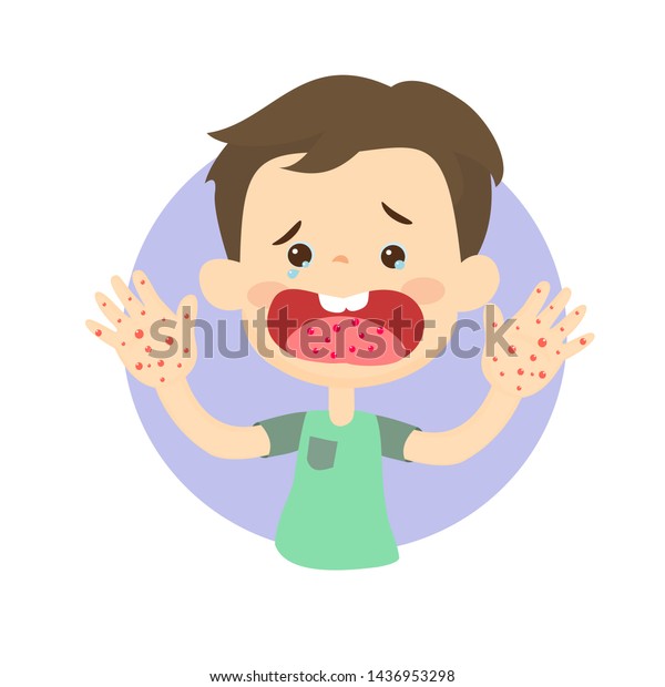 Hand Foot Mouth Disease Thomson Medical Stock Vector (royalty Free 