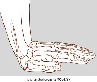 hand fracture