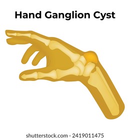 Hand Ganglion Cyst Science Design Vector Illustration Diagtram