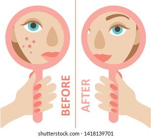 A hand holding a mirror reflecting the face of a young girl with acne and without. Flat vector on white background