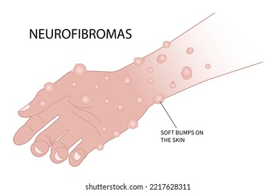 Hand with light brown spots on the skin or Neurofibroma spinal cord Freckles disease