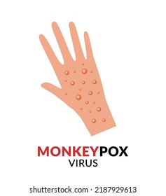 Hand with monkeypox flat design vector Illustration. Disease spread alert.
Outbreak virus infections
