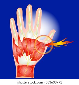 Hand pain Area Nerve isolates vector.With fire spot indicating location of the pain. 
