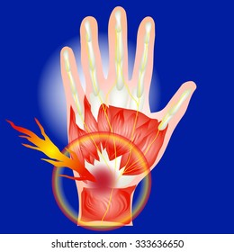 Hand pain Joints, bones isolates vector.With fire spot indicating location of the pain. 