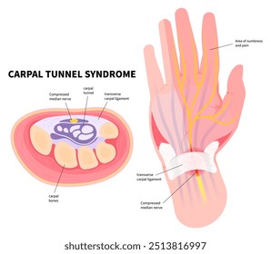 Hand pain with the Quervain's tenosynovitis disease sign and Carpal tunnel syndrome test