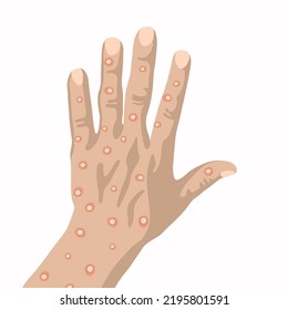 The hand of a person who got smallpox.