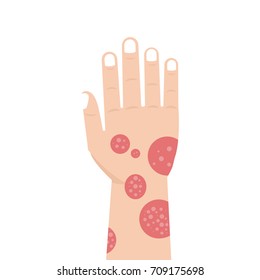 Hand with psoriasis or Eczema. Vector illustration.