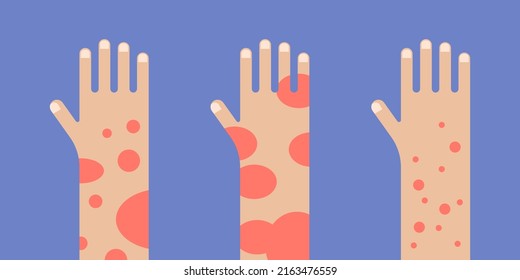 Hand with psoriasis wounds. People suffering from psoriasis banner vector illustration.