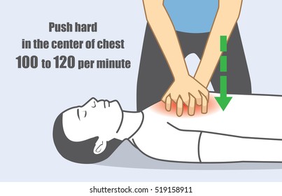 Hand push hard and fast in the center. Illustration about perform CPR for person has stopped breathing. 