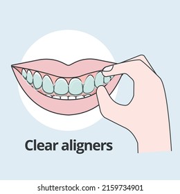 Hand putting on clear aligners Orthodontist vector illustrator