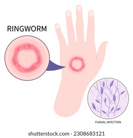 Hand with ringworm eczema psoriasis or Jock itch skin fungal rash body leg fungus tinea cruris dermatophytosis Itchiness Scaly athlete's circular excessive infection