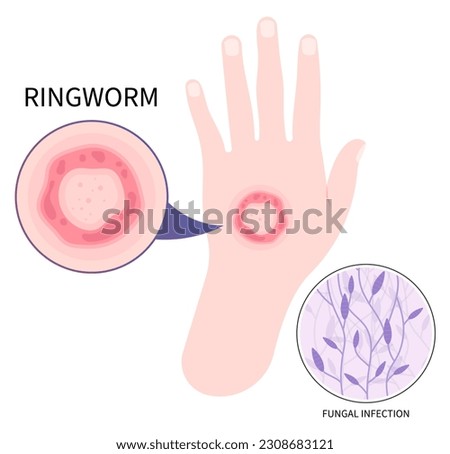 Hand with ringworm eczema psoriasis or Jock itch skin fungal rash body leg fungus tinea cruris dermatophytosis Itchiness Scaly athlete's circular excessive infection Foto d'archivio © 