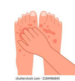 Hand scratching foot in flat design. Man or woman suffering from strong allergy skin itchy symptom concept. Red rash skin irritation.