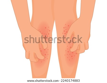 hand scratching itchy leg with rash dry skin because of allergic reaction