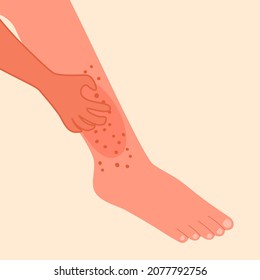 Hand scratching leg in flat design. Man or woman suffering from strong allergy skin itchy symptom concept. Red rash skin irritation.