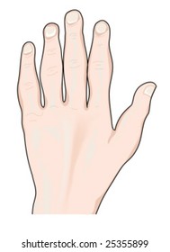 Hand Showing Arthritic Changes