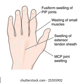 Hand showing arthritic changes - labeled