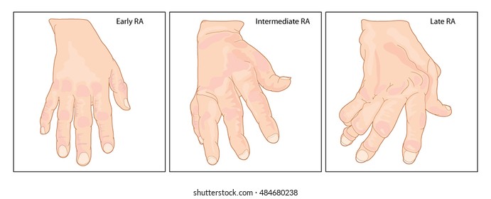 A Hand Showing Early, Intermediate And Late Rheumatoid Arthritis With Typical Joint Swelling And Deformation Of The Fingers And Knuckles